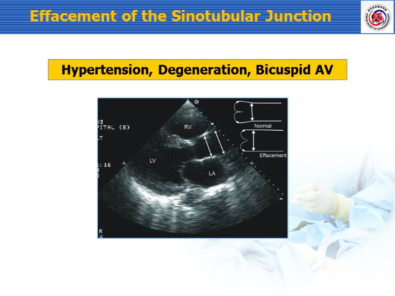 Effacement of the Sinotubular Junction Hypertension, Degeneration, Bicuspid AV